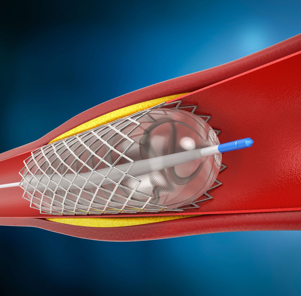Vascular treatments for arteries | Island Cardiovascular and Vein...